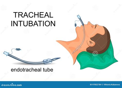 Endotracheal Intubation On Scientific Background Royalty-Free Cartoon | CartoonDealer.com #277610417