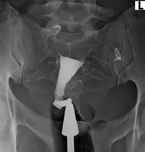 Venous Intravasation Hysterosalpingography Image Radiopaedia Org