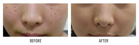 Before And After Cleopatra Laser Skin Clinic