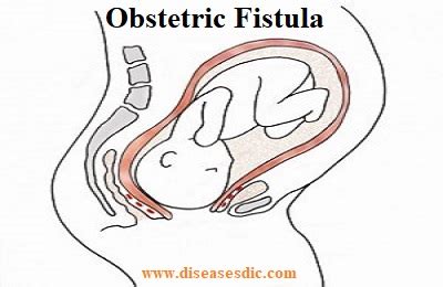 Obstetric Fistula – Causes, Complications, and Treatment.