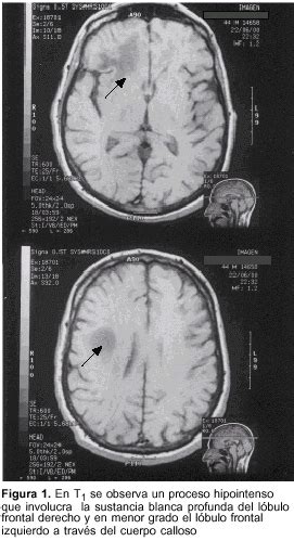 Leucoencefalopatía multifocal progresiva a propósito de un caso