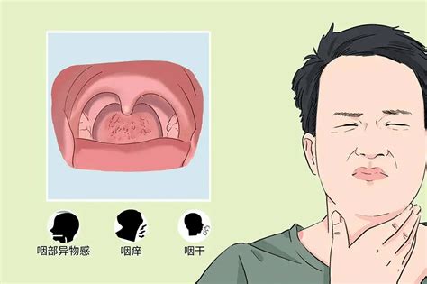 慢性咽炎患者必看这些人更容易患上咽炎你中招了吗 生活 炎症 治疗