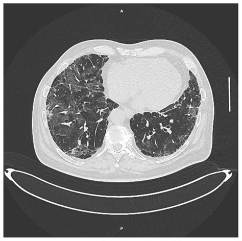 Microorganisms Free Full Text Prevalence Of Pneumocystis Jirovecii Colonization In Non