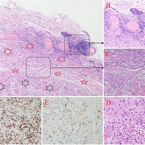 Histology And Immunohistochemistry Of Inflammatory Myofibroblastic