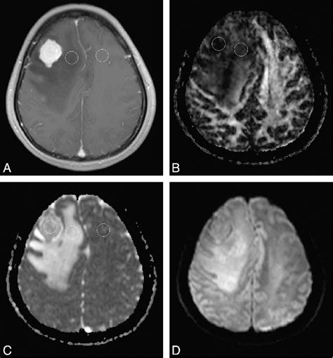 Figure From Differentiation Between Classic And Atypical Meningiomas