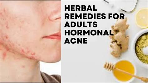 Unlock Clearer Skin With Herbal Remedies For Adult Hormonal Acne