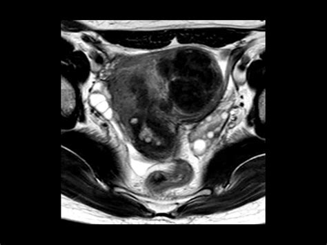 Female Pelvis Philips Mr Body Map