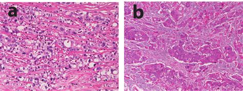 Histology of case 1. Tumor cells are composed of adenocarcinoma (poorly... | Download Scientific ...