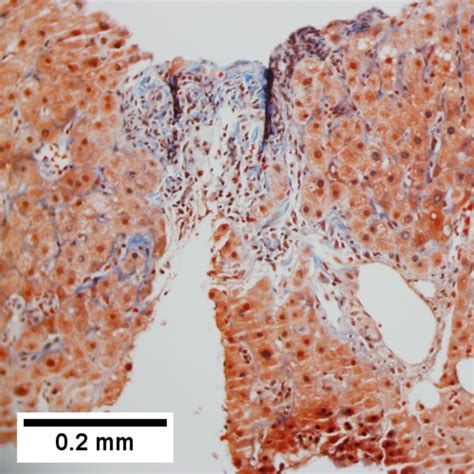 Primary Biliary Cirrhosis Libre Pathology