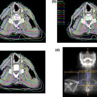 Optimization Of The Volumetric Modulated Arc Therapy VMAT Planning