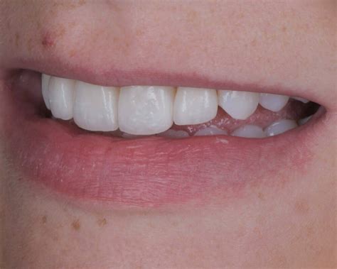 Veneers for Crooked Teeth - Can Veneers Align your Smile?