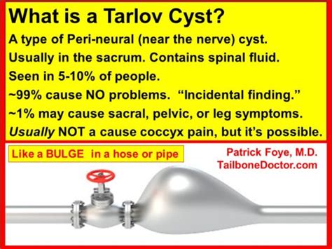 How To Tell Tarlov Cyst Pain From Tailbone Pain Coccyx Pain Tailbone Doctor