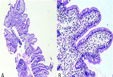 Morphological Features On Duodenal Biopsy A Low Power View Showing