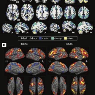 Spatial Overlap Of Task Related FMRI Activation For 2 Back Greater Than