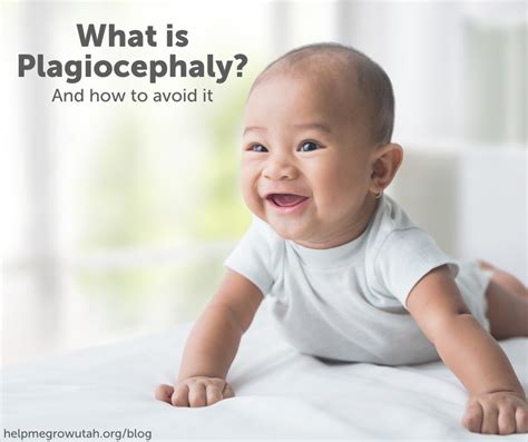 What is Plagiocephaly?