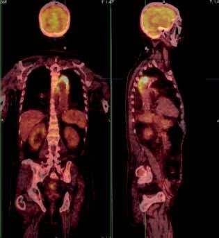 Fused Pet Ct Image Of The Mycotic Aneurysm Of The Descending Thoracic