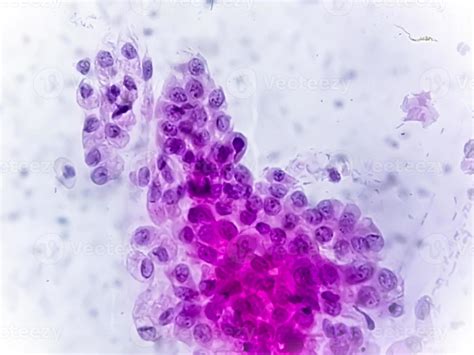 Microscopic View Of Trichomonas Vaginalis In Pap Smear With Few Acute Inflammatory Cells