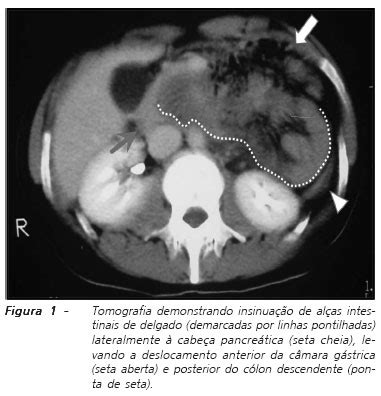 Scielo Brasil H Rnia Paraduodenal Esquerda H Rnia Paraduodenal Esquerda