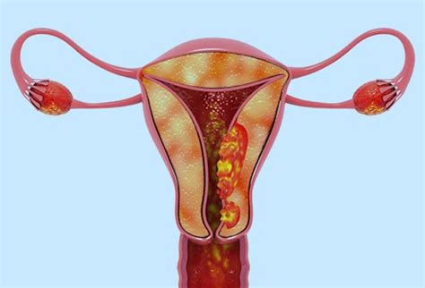 Uterine Cancer Diagnosis, Stages, Treatment & Causes - Okkii.com