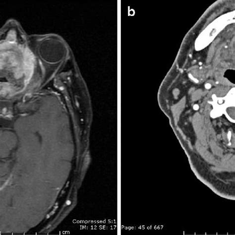 A Magnetic Resonance Imaging T1 Fat Sat And Gadolinium Showing A Download Scientific Diagram