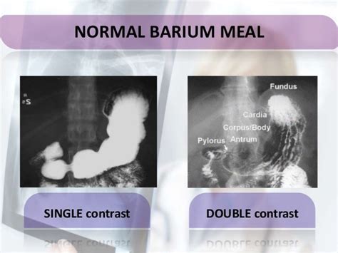 Barium Meal