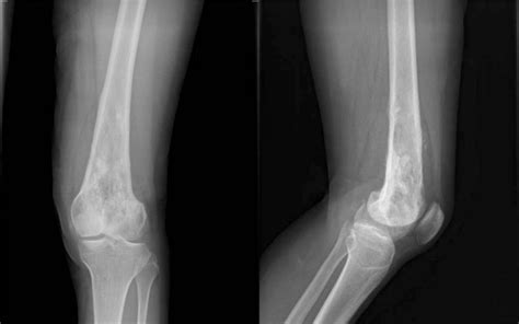 Fibroma x ray - wikidoc