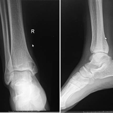 (a) Postoperative ankle X-ray anteroposterior view. (b) Postoperative ...