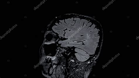 La Visi N Sagital De Las Exploraciones Cerebrales Por Resonancia