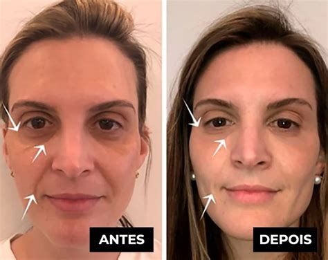 Derma Fix Funciona Alerta A Verdade Revelada