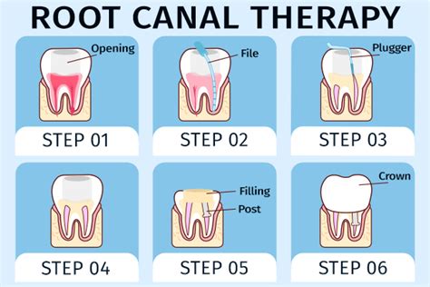 Understanding Pulpotomy Pulpectomy Root Canal Therapy