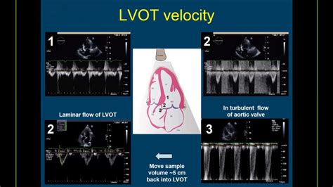 Guideline Based Webinar On The Echo Assessment Of Aortic Valve Stenosis