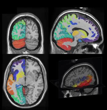 Brain atlas - encyclopedia article - Citizendium