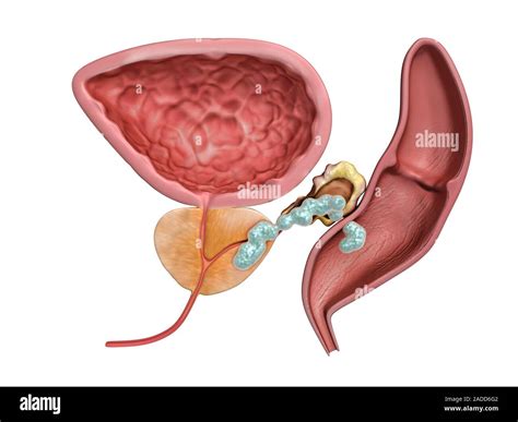 Stage Iv Prostate Cancer Illustration Of Part Of The Male Reproductive System In Vertical