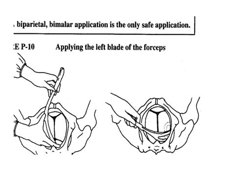 Forceps Delivery And Vaccum Extraction Ppt