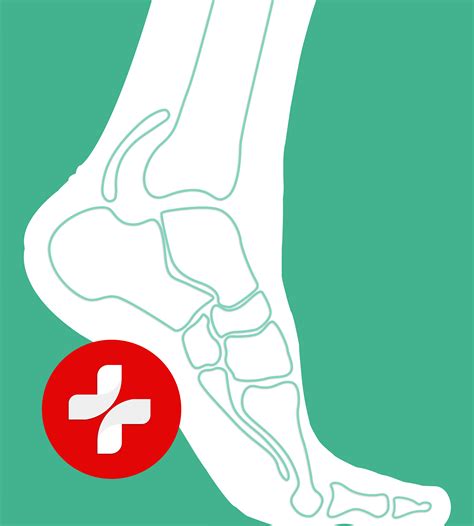 Expert Corn Removal & Plantar Fasciitis Treatment in Singapore