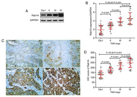 Expression Of Rab1a In Bladder Cancer And Its Clinical Implications