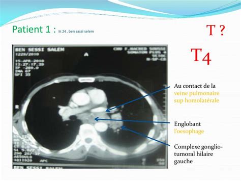 Ppt Imagerie Du Cancer Bronchique And Classification Tnm Powerpoint