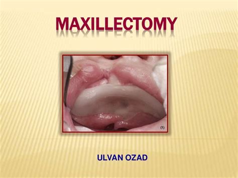 Maxillectomy