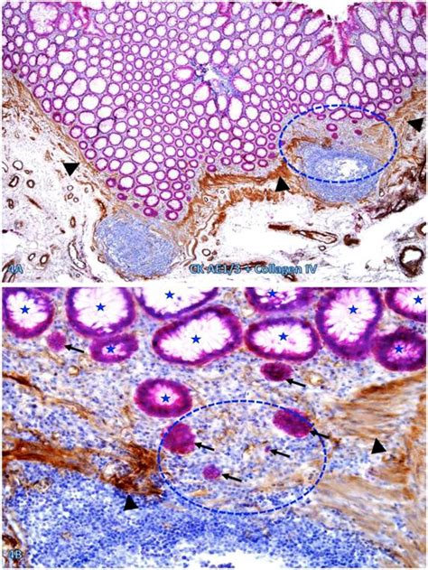 Tumor Infiltrating Immune Cells Triggers For Tumor Capsule Disruption