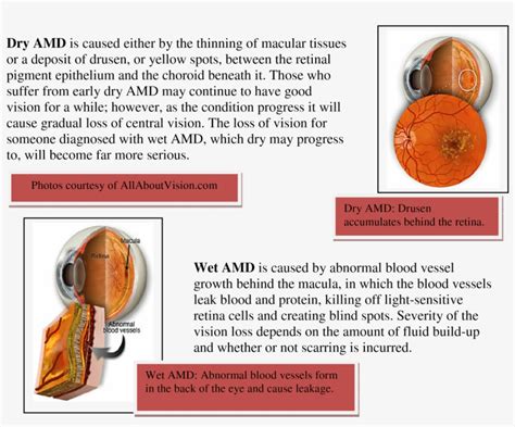 Macular Degeneration Eye Chart Printable