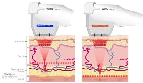 O Que é Ultrassom Microfocado E Como Trata A Flacidez Facial E Corporal Especialista Lasers