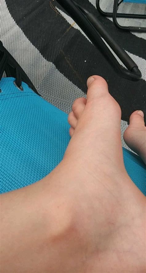 How To Quickly Heal A Sprained Ankle Artofit