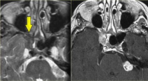 Nasal Polyp Mri