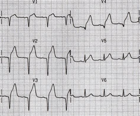 Coronary Artery Disease Clinical Case