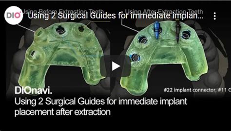 Using 2 Surgical Guides For Immediate Implant Placement After