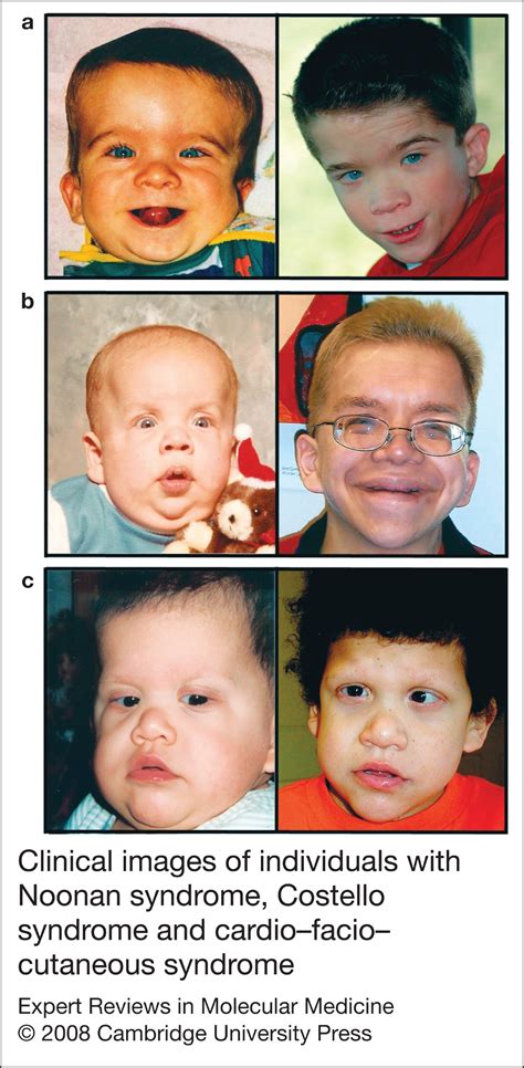 Noonan Costello And Cardiofaciocutaneous Syndromes Dysregulation Of