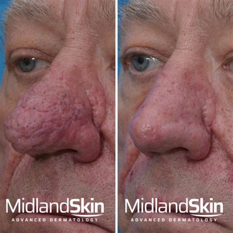 Mild Rhinophyma Pictures