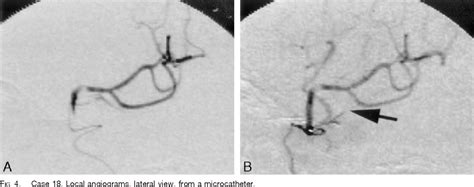 Recanalization By Mechanical Embolus Disruption During Intra Arterial