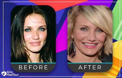 Celebrity Nose Job Pictures Photos Of Stars Before And After | Hot Sex Picture