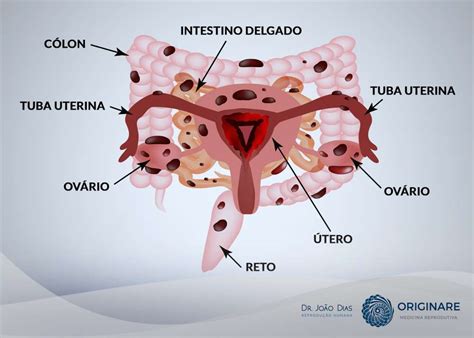 Endometriose profunda saiba mais sobre a doença Dr João Dias